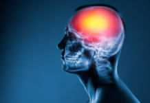 ¿Por qué aumentan los accidentes cerebrovasculares entre los jóvenes?